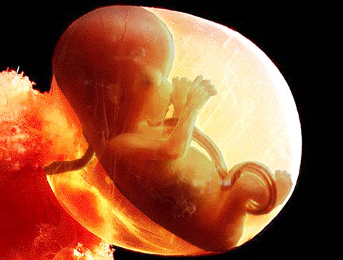 Abortion Pictures 5 Weeks. 12-16 weeks gestation